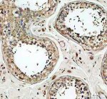 CEP55 Antibody Human Testicular Cancer IHC. Immunohistochemical staining of FFPE human testicular cancer tissue using CEP55 antibody at 2 ug/ml following heat-induced epitope retrieval in pH8 EDTA buffer. Detection was performed using an HRP-conjugated secondary antibody with DAB chromogen. CEP55 immunoreactivity is observed predominantly within the cytoplasm of tumor cells, with widespread staining throughout the neoplastic tissue, consistent with the increased expression of this cytokinesis regulator in actively proliferating cells. This result demonstrates that the CEP55 Antibody / Cytokinesis Protein Antibody is suitable for immunohistochemical detection of endogenous CEP55 in formalin-fixed, paraffin-embedded human tissues.