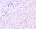 SGCD Antibody Human Stomach Carcinoma IHC. Immunohistochemical analysis of FFPE human stomach carcinoma tissue using SGCD Antibody / Sarcoglycan Family Protein Antibody, clone AbS97. Heat-induced epitope retrieval was performed in Tris-EDTA buffer (pH 8.0-8.4) for 20 minutes. The recombinant rabbit monoclonal antibody was applied at a 1:100 dilution, and staining was visualized using an HRP polymer detection system with DAB chromogen. Membranous and cytoplasmic staining is observed within the tumor tissue, consistent with SGCD expression, while hematoxylin provides nuclear counterstaining. This SGCD Antibody, also called Sarcoglycan Family Protein Antibody, is suitable for studies of sarcoglycan biology, muscle membrane stability, dystrophin-associated protein complexes, and skeletal and cardiac muscle physiology.