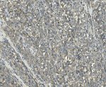PPM1E Antibody Human Melanoma IHC. Immunohistochemical staining of FFPE human melanoma tissue using PPM1E Antibody / Protein Phosphatase 1E Antibody. Heat-induced epitope retrieval was performed in pH 8.0 EDTA buffer before incubation with PPM1E Antibody at 1 ug/ml. A biotinylated goat anti-rabbit secondary antibody with an SABC detection system and DAB chromogen was used for visualization. PPM1E exhibits predominantly cytoplasmic staining in melanoma cells, consistent with its role as a PP2C family serine/threonine phosphatase that regulates phosphorylation-dependent signaling pathways. This PPM1E Antibody, also called Protein Phosphatase 1E Antibody, is suitable for studies of protein dephosphorylation, MAPK signaling, neuronal signaling, and cancer-associated signal transduction.