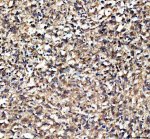 EPB41L5 Antibody Human Melanoma IHC. Immunohistochemical staining of FFPE human melanoma tissue using EPB41L5 antibody demonstrated predominantly membranous and cytoplasmic staining in tumor cells, consistent with the role of EPB41L5 in epithelial-mesenchymal transition, cell adhesion remodeling, and cell migration. Heat-induced epitope retrieval was performed in pH 8.0 EDTA buffer prior to staining. Tissue sections were blocked with 10% goat serum and incubated with the primary antibody (2 ug/ml) overnight at 4Â°C, followed by a peroxidase-conjugated goat anti-rabbit IgG secondary antibody. Immunoreactivity was visualized using an HRP Super Vision detection system with DAB as the chromogen. This EPB41L5 Antibody, also called an Epithelial-Mesenchymal Transition Protein Antibody, is useful for investigating epithelial-mesenchymal transition, cell adhesion remodeling, tumor invasion, and cancer metastasis.
