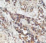 EPB41L5 Antibody Human Lung Cancer IHC. Immunohistochemical staining of FFPE human lung cancer tissue using EPB41L5 antibody demonstrated predominantly membranous and cytoplasmic staining in malignant cells, consistent with the role of EPB41L5 in epithelial-mesenchymal transition, cell adhesion remodeling, and tumor cell migration. Heat-induced epitope retrieval was performed in pH 8.0 EDTA buffer prior to staining. Tissue sections were blocked with 10% goat serum and incubated with the primary antibody (2 ug/ml) overnight at 4Â°C, followed by a peroxidase-conjugated goat anti-rabbit IgG secondary antibody. Immunoreactivity was visualized using an HRP Super Vision detection system with DAB as the chromogen. This EPB41L5 Antibody, also called an Epithelial-Mesenchymal Transition Protein Antibody, is useful for investigating epithelial-mesenchymal transition, cell adhesion remodeling, tumor invasion, and metastatic progression.