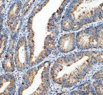 MRPS35 Antibody Human Colon Cancer IHC. Immunohistochemical staining of FFPE human colon cancer tissue shows MRPS35 expression following heat-induced epitope retrieval in pH8 EDTA buffer. Brown DAB staining is observed predominantly within the cytoplasm of tumor epithelial cells, consistent with the mitochondrial localization of mitochondrial ribosomal protein S35, while nuclei are counterstained blue with hematoxylin. The staining pattern supports expression of this mitochondrial translation factor in colorectal carcinoma tissue. This MRPS35 Antibody is suitable for studies of mitochondrial ribosomal protein S35, mitochondrial biology, and cancer-associated metabolic regulation.