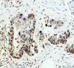 MRPS35 Antibody Human Lung Cancer IHC. Immunohistochemical staining of FFPE human lung cancer tissue demonstrates MRPS35 expression following heat-induced epitope retrieval in pH8 EDTA buffer. Brown DAB staining is observed predominantly within the cytoplasm of malignant epithelial cells, with variable staining intensity among tumor cells, while nuclei are counterstained blue with hematoxylin. The localization is consistent with the mitochondrial distribution of mitochondrial ribosomal protein S35. This MRPS35 Antibody is suitable for studies of mitochondrial ribosomal protein S35, mitochondrial translation, and metabolic adaptations associated with lung cancer.