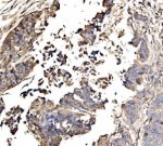 GNAL Antibody Human Lung Cancer IHC. IHC staining of FFPE human lung cancer tissue using GNAL Antibody (A09404-1). Heat-induced epitope retrieval was performed in EDTA buffer (pH 8.0), followed by blocking with 10% goat serum. The tissue was incubated with the antibody at 2 ug/ml overnight at 4Â°C, followed by biotinylated goat anti-rabbit IgG and SABC/DAB detection. Positive GNAL staining is observed in tumor cells. This GNAL Antibody demonstrates G(olf) alpha expression in human lung cancer tissue, supporting research into G protein-mediated signaling.