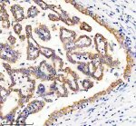 UBE3C Antibody in Human Lung Cancer IHC. Immunohistochemistry staining of FFPE human lung cancer tissue with UBE3C Antibody / Ubiquitin Protein Ligase E3C Antibody at 2 ug/ml. Heat-induced epitope retrieval (HIER) was performed in EDTA buffer, pH 8.0, followed by blocking with 10% goat serum. The tissue was incubated with the primary antibody overnight at 4oC, followed by a peroxidase-conjugated goat anti-rabbit IgG secondary antibody for 30 min at 37oC and DAB detection. UBE3C staining is observed in the lung tumor cells. This UBE3C Antibody demonstrates detection of Ubiquitin Protein Ligase E3C in human lung cancer tissue.