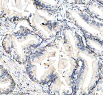 CYP17A1 Antibody in Human Prostate Cancer IHC. Immunohistochemistry staining of FFPE human prostate cancer tissue with CYP17A1 Antibody / Steroid 17-Alpha-Hydroxylase Antibody. Tissue sections underwent HIER in EDTA buffer, pH 8.0, and were blocked with 10% goat serum. The antibody was used at 1:50 overnight at 4oC, followed by a peroxidase-conjugated goat anti-rabbit IgG secondary antibody and DAB detection. The observed staining demonstrates CYP17A1 expression in human prostate cancer tissue.