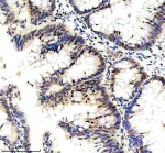 KIF4A Antibody 24K13 in Human Colon Cancer IHC. Immunohistochemistry staining of FFPE human colon cancer tissue with KIF4A Antibody 24K13 / Mitotic Kinesin Marker, clone 24K13, at 1:50 overnight at 4oC. HIER was performed using EDTA buffer, pH 8.0, followed by blocking with 10% goat serum. HRP/DAB detection demonstrates KIF4A staining in human colon cancer tissue.