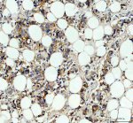 Carbonic Anhydrase XII Antibody by IHC in human breast cancer with membranous staining. Immunohistochemistry of FFPE human breast cancer tissue using Carbonic Anhydrase XII Antibody at 2 ug/ml. Brown immunoreactivity is distributed along the membranes and cytoplasm of numerous tumor-associated cells, with distinct cellular boundaries and relatively limited background staining. Hematoxylin counterstaining identifies blue-purple nuclei throughout the section. Heat-mediated antigen retrieval was performed in EDTA buffer at pH 8.0, followed by overnight primary antibody incubation at 4oC. This CA12 Polyclonal Antibody demonstrates membrane-associated immunoreactivity consistent with the localization of carbonic anhydrase XII.