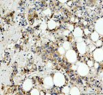 Carbonic Anhydrase XII Antibody by IHC in human breast cancer with heterogeneous tumor staining. Immunohistochemistry of FFPE human breast cancer tissue using Carbonic Anhydrase XII Antibody at 2 ug/ml. Moderate-to-strong brown immunoreactivity is observed in tumor-associated cells, with predominantly membranous and cytoplasmic staining. Signal intensity varies among neighboring cells, producing a heterogeneous distribution. Hematoxylin counterstaining highlights blue-purple nuclei. Heat-mediated antigen retrieval was performed using EDTA buffer at pH 8.0, followed by overnight incubation at 4oC. This CA12 Polyclonal Antibody demonstrates immunoreactivity within the cellular components of breast cancer tissue.