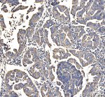 DLST Antibody by IHC in human colon cancer. Immunohistochemistry of FFPE human colon cancer tissue using DLST Antibody at 2 ug/ml. Brown DAB immunoreactivity is detected in the tissue section, with hematoxylin counterstaining highlighting cellular and glandular architecture. Heat-induced epitope retrieval was performed using EDTA buffer at pH 8.0, followed by overnight primary antibody incubation at 4oC. This Dihydrolipoamide Succinyltransferase Antibody detects the mitochondrial E2 component of the alpha-ketoglutarate dehydrogenase complex.
