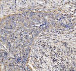 DLST Antibody by IHC in human lung cancer. Immunohistochemistry of FFPE human lung cancer tissue using DLST Antibody at 2 ug/ml. Brown DAB immunoreactivity is detected in the tissue section, demonstrating DLST expression. Hematoxylin counterstaining highlights nuclei and surrounding tissue architecture. Heat-induced epitope retrieval was performed using EDTA buffer at pH 8.0, followed by overnight primary antibody incubation at 4oC. This Dihydrolipoamide Succinyltransferase Antibody recognizes a mitochondrial enzyme involved in cellular energy metabolism.
