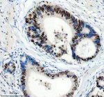 PPIG Antibody by IHC in Human Gastric Carcinoma Glands. Immunohistochemistry staining of FFPE human stomach cancer tissue using rabbit polyclonal PPIG antibody at 2 ug/ml. Cyclophilin G immunoreactivity is observed in malignant glandular epithelial cells, with prominent nuclear-associated brown staining and variable cytoplasmic labeling. The tumor glands show relatively strong staining compared with adjacent stromal elements, which exhibit limited immunoreactivity. Heat-induced antigen retrieval was performed using EDTA buffer (pH 8.0), followed by overnight primary antibody incubation at 4oC and DAB-based detection.