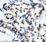 PPIG Antibody by IHC in Human Breast Carcinoma Tissue. Immunohistochemistry staining of FFPE human breast cancer tissue using rabbit polyclonal PPIG antibody at 2 ug/ml. Cyclophilin G expression is demonstrated by brown nuclear-associated staining in a subset of tumor cells, with variable intensity across the tissue section. Some cells exhibit additional diffuse cytoplasmic labeling, while others remain predominantly hematoxylin-positive. Heat-induced antigen retrieval was performed using EDTA buffer (pH 8.0), followed by overnight primary antibody incubation at 4oC and DAB-based detection.