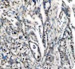 PPIG Antibody by IHC in Human Pancreatic Carcinoma with Stromal Infiltration. Immunohistochemistry staining of FFPE human pancreatic cancer tissue using rabbit polyclonal PPIG antibody at 2 ug/ml. Cyclophilin G immunoreactivity is detected in scattered tumor cells within a prominent stromal background, with variable nuclear-associated and weak cytoplasmic staining. The heterogeneous labeling pattern contrasts with numerous surrounding cells showing little detectable immunoreactivity. Heat-induced antigen retrieval was performed using EDTA buffer (pH 8.0), followed by overnight primary antibody incubation at 4oC and DAB-based detection.