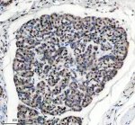 PPIG Antibody by IHC in Human Pancreatic Carcinoma Cell Clusters. Immunohistochemistry staining of a second FFPE human pancreatic cancer section using rabbit polyclonal PPIG antibody at 2 ug/ml. Cyclophilin G immunoreactivity is observed in densely arranged tumor cells, with moderate nuclear-associated staining and variable cytoplasmic labeling. The tumor cell clusters exhibit more extensive staining than the surrounding stromal regions. Heat-induced antigen retrieval was performed using EDTA buffer (pH 8.0), followed by overnight primary antibody incubation at 4oC and DAB-based detection.