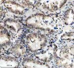 PPIG Antibody by IHC in Human Lung Carcinoma Tissue. Immunohistochemistry staining of FFPE human lung cancer tissue using rabbit polyclonal PPIG antibody at 2 ug/ml. Cyclophilin G immunoreactivity is observed in malignant epithelial cells, with brown nuclear-associated staining and variable cytoplasmic labeling. Tumor cells surrounding glandular structures show heterogeneous staining intensity, while intervening stromal cells are comparatively weakly labeled. Heat-induced antigen retrieval was performed using EDTA buffer (pH 8.0), followed by overnight primary antibody incubation at 4oC and DAB-based detection.