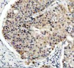 PPIG Antibody by IHC in Human Liver Carcinoma Tissue. Immunohistochemistry staining of FFPE human liver cancer tissue using rabbit polyclonal PPIG antibody at 2 ug/ml. Cyclophilin G expression is demonstrated by heterogeneous brown staining in tumor cells, involving both nuclear and cytoplasmic compartments. Some cells show relatively strong nuclear-associated labeling, while others exhibit weaker diffuse staining. Heat-induced antigen retrieval was performed using EDTA buffer (pH 8.0), followed by overnight primary antibody incubation at 4oC and DAB-based detection.