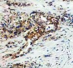 DNAAF4 Antibody by IHC in Human Pancreatic Cancer Tissue. Immunohistochemistry analysis of DNAAF4 in a paraffin-embedded human pancreatic cancer section using DNAAF4 Antibody. Brown DAB immunoreactivity is visible in groups of tumor cells, with variable intensity across the field. Blue hematoxylin counterstaining outlines nuclei and highlights the surrounding fibrous stroma, which exhibits comparatively little brown labeling. Antigen retrieval was performed in EDTA buffer at pH 8.0, followed by 10% goat serum blocking and incubation with 2 ug/ml primary antibody overnight at 4oC. A peroxidase-conjugated secondary antibody and DAB chromogen were used for visualization. The Dynein axonemal assembly factor 4 Antibody detects staining in this tissue.
