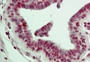LSD1 Antibody Breast Cancer Immunohistochemistry. IHC testing of FFPE human breast tissue with LSD1 antibody at 5ug/ml. HIER: steam tissue sections in pH6, 10mM citrate buffer, for 10-20 min followed by cooling at RT for 20 min.