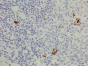 Human IgG3 Antibody Immunohistochemistry Human Lymphoid Tissue. Immunohistochemistry analysis of FFPE human lymphoid tissue using Human IgG3 Antibody / Anti-Human IgG3 Detection Antibody (clone RM119) demonstrates scattered cytoplasmic staining in lymphoid cells consistent with immunoglobulin-producing cell populations, while surrounding cells remain largely negative. This staining pattern reflects detection of IgG3 / IGHG3 within antibody-secreting cells and supports the use of this antibody for identifying IgG3-expressing cell populations in tissue sections. Heat-induced epitope retrieval was performed using either pH6 citrate buffer or pH9 Tris-EDTA buffer prior to antibody incubation.