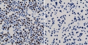 His Tag Antibody Human 293T Cell ICC. Immunocytochemistry was performed using recombinant His Tag Antibody clone RM146 on human HEK293T cells expressing a His-tagged nuclear protein (left) and negative control HepG2 cells lacking the tagged protein (right). Bound antibody was visualized with an HRP-conjugated secondary antibody and DAB chromogen, followed by hematoxylin counterstaining. Strong nuclear staining is observed in the HEK293T cells expressing the His-tag fusion protein, while the negative control cells show no detectable staining. These results demonstrate that this Polyhistidine Tag Antibody specifically detects His-tagged recombinant proteins in immunocytochemistry applications with minimal background.