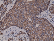 HER2 Antibody Breast Cancer Tissue IHC. Immunohistochemistry analysis of FFPE human breast carcinoma tissue using HER2 Antibody demonstrates strong HRP-DAB brown membranous staining outlining tumor epithelial cells, consistent with ErbB2 / HER2 expression as a receptor tyrosine kinase, while surrounding stromal elements show minimal signal; nuclei are counterstained blue.