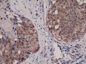 Recombinant AKT1 Antibody Breast Cancer IHC. Immunohistochemistry testing of FFPE human breast cancer tissue with Recombinant AKT1 Antibody at 1:1000.