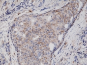 CD44 Antibody Extracellular Domain Breast Cancer IHC. Immunohistochemistry analysis of CD44 / CD44 antigen expression in FFPE human breast cancer tissue using recombinant rabbit monoclonal antibody clone RM264. Membranous HRP-DAB brown staining is observed in tumor epithelial cells, outlining cell borders and highlighting cell surface localization consistent with extracellular domain detection of CD44. The staining pattern demonstrates heterogeneous expression across tumor cells and supports its use as a marker of cell surface distribution and tumor cell interaction within breast carcinoma tissue. Heat induced epitope retrieval was performed by boiling tissue sections in pH 9 10mM Tris with 1mM EDTA for 20 min followed by cooling at RT before testing.