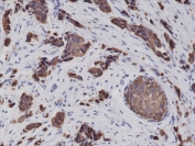 CK8 Antibody Breast Cancer IHC. Immunohistochemical staining of FFPE human breast cancer tissue using recombinant CK8 Antibody (clone RM266) at a 1:2000 dilution demonstrates strong cytoplasmic and membranous HRP-DAB brown staining within malignant epithelial cells. The staining pattern is consistent with expression of Cytokeratin 8 (CK8/KRT8), a type II intermediate filament protein widely expressed in simple epithelial tissues and epithelial-derived carcinomas. CK8 immunoreactivity highlights neoplastic epithelial cell populations and supports evaluation of epithelial differentiation and tumor-associated cytoskeletal organization in breast cancer specimens.