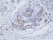 Estrogen Receptor alpha Antibody N-Terminal Region IHC. Immunohistochemistry staining of formalin fixed and paraffin embedded human breast cancer tissue using recombinant Estrogen Receptor alpha antibody at a 1:100 dilution. HIER: steam section in pH6 citrate buffer for 20 min and allow to cool prior to testing.