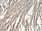 CD34 Antibody Gastrointestinal Stromal Tumor IHC. Immunohistochemistry testing of formalin fixed and paraffin embedded human gastrointestinal stromal tumor tissue with recombinant CD34 antibody at 1:400 dilution. HIER: steam section in pH6 citrate buffer for 20 min and allow to cool prior to staining.