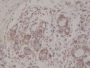AKT Antibody Breast Cancer Tissue IHC. Immunohistochemistry of FFPE human breast carcinoma tissue using AKT antibody shows HRP-DAB brown cytoplasmic and nuclear staining in tumor epithelial cells, consistent with PI3K-dependent AKT signaling and membrane recruitment dynamics mediated by the PH domain, while surrounding stromal cells display lower background; detection was performed at 1:500 dilution using clone RM316. HIER: steam tissue sections in pH6 citrate buffer for 20 min and allow to cool prior to staining.