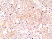 PD-L1 Antibody Lung Cancer IHC. Immunohistochemistry analysis of PD-L1 (CD274) expression in FFPE human lung cancer tissue using recombinant rabbit monoclonal clone RM320 at 1:1000. The antibody demonstrates membranous HRP-DAB brown staining in tumor epithelial cells with additional signal in scattered tumor-associated immune cells, consistent with immune checkpoint activity within the tumor microenvironment. The staining pattern shows heterogeneous expression across tumor regions, supporting evaluation of PD-L1 distribution and tumor-immune interactions.