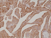 Prostate Specific Antigen Antibody Biotin Conjugate Prostate Cancer IHC. Immunohistochemistry staining of FFPE human prostate cancer tissue with recombinant Prostate Specific Antigen antibody at 1:1000.