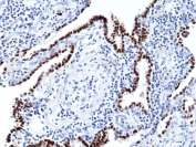 NKX2.1 Antibody Lung Cancer Tissue IHC. Immunohistochemical staining of FFPE human lung cancer tissue using NKX2.1 Antibody. Distinct nuclear staining is observed in neoplastic cells, consistent with the expression pattern of NKX2.1 in pulmonary epithelial-derived tumors. This result demonstrates the utility of NKX2.1 as a lineage-specific biomarker for lung cancer and supports its use in studies of pulmonary differentiation and tumor classification.