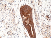 Recombinant VEGFA Antibody Human Breast Cancer IHC. Immunohistochemical staining of FFPE human breast cancer tissue using Recombinant VEGFA Antibody (clone RM391) at 1:100 dilution. An HRP-conjugated secondary antibody with DAB substrate was used for detection. Recombinant VEGFA Antibody demonstrates strong VEGFA expression in breast tumor cells and vascular-associated regions, supporting studies of tumor angiogenesis, endothelial cell signaling, vascular remodeling, and VEGF-mediated regulation of the cancer microenvironment.