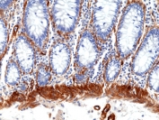 Caldesmon Antibody / CALD1 Cell Adhesion and Structural Connectivity Protein Antibody. Immunohistochemistry analysis of Caldesmon (CALD1) in human colon tissue. FFPE human colon stained with Caldesmon Antibody at 1:100 demonstrates strong HRP-DAB brown cytoplasmic staining in smooth muscle cells of the muscularis layer and along the base of the mucosa. The staining highlights elongated, organized cell layers with dense filament-associated cytoplasmic signal consistent with cytoskeletal linkage at sites of structural connectivity and tissue anchoring. Epithelial cells lining the crypts show minimal staining, supporting localization of CALD1 to cytoskeletal networks that contribute to adhesion-associated structural integrity.