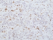 Myeloperoxidase Antibody Cholangiocarcinoma IHC. Immunohistochemistry staining of FFPE human cholangiocarcinoma tissue with recombinant Myeloperoxidase antibody at 1:100.