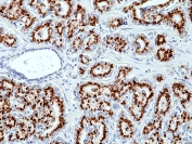 Prostein Antibody for IHC. Immunohistochemistry analysis of Prostein / SLC45A3 antibody staining in FFPE human prostate cancer tissue. Strong cytoplasmic and perinuclear staining is observed in tumor epithelial cells forming irregular glandular structures, consistent with Golgi-associated localization of Prostein, while surrounding stromal components remain largely negative. The staining highlights androgen-responsive tumor epithelial populations and supports retention of SLC45A3 expression in prostate-derived carcinoma. The antibody was applied at a dilution of 1:100 following heat-induced epitope retrieval in pH 9 Tris-EDTA buffer for 20 minutes and cooling prior to incubation.