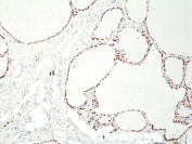 PAX8 Antibody / Epithelial Lineage Transcription Factor Antibody immunohistochemistry in human thyroid tissue showing strong nuclear HRP-DAB brown staining in follicular epithelial cells. Paired box protein Pax-8 (PAX8) expression is localized to nuclei lining well-defined thyroid follicles, with clear staining of epithelial cells surrounding colloid-filled lumina and minimal signal in stromal or interstitial compartments. The nuclear staining pattern highlights transcriptionally active epithelial cells and supports the role of PAX8 as a lineage-defining transcription factor regulating epithelial identity. Negative cells retain hematoxylin-only nuclear staining, providing clear contrast for interpretation within preserved tissue architecture.