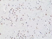 IHC staining of FFPE human brain cancer tissue with recombinant HDCAC3 antibody at 1:200.