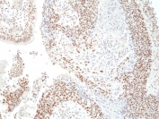 IHC staining of FFPE human lung squamous carcinoma tissue with recombinant HDCAC3 antibody at 1:200.