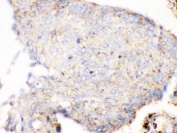 Cathepsin D Antibody Lung Cancer Immunohistochemistry. IHC testing of FFPE human lung cancer tissue with Cathepsin D antibody. HIER: steamed with pH6 citrate buffer, HRP-staining.