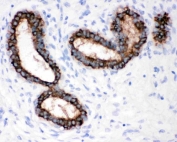 IHC staining of FFPE human breast cancer tissue with Cytokeratin 18 antibody. HIER: boil tissue sections in pH8 EDTA for 20 min and allow to cool before testing.