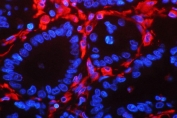 Vimentin Antibody Clone V9. Immunofluorescence analysis of Vimentin / VIM in human intestinal cancer tissue showing strong cytoplasmic and filamentous staining (red) in stromal and mesenchymal-like cells, surrounding epithelial tumor structures. The highly published mouse monoclonal clone V9 highlights the characteristic intermediate filament network distribution of Vimentin, with signal concentrated in the cytoplasm and extending along cellular processes. Nuclei are counterstained with DAPI (blue), and the staining pattern is consistent with known Vimentin expression in tumor-associated stromal cells and cells undergoing mesenchymal transition.