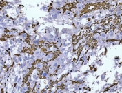 IHC staining of FFPE human invasive urothelial carcinoma tissue with Vimentin antibody. HIER: boil tissue sections in pH8 EDTA for 20 min and allow to cool before testing.
