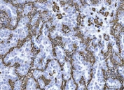 IHC staining of FFPE human lung adenocarcinoma tissue with Vimentin Antibody Clone V9. HIER: boil tissue sections in pH8 EDTA for 20 min and allow to cool before testing.