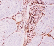 Immunohistochemistry analysis of P Glycoprotein (MDR1) expression. P Glycoprotein antibody staining was performed on formalin-fixed, paraffin-embedded human lung cancer tissue, showing membranous and cytoplasmic DAB signal in subsets of tumor-associated cells, with surrounding tumor regions largely negative. Heat-induced epitope retrieval was carried out by steaming sections in citrate buffer (pH 6.0) for 20 minutes, followed by detection using an HRP-conjugated secondary antibody and DAB chromogen.