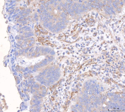 Immunohistochemical staining of FFPE human rectal cancer tissue with ANG2 antibody, HRP-secondary and DAB substrate. HIER: boil tissue sections in pH8 EDTA for 20 min and allow to cool before testing.