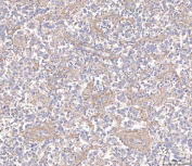 Immunohistochemical staining of FFPE human testis cancer tissue with ANG2 antibody, HRP-secondary and DAB substrate. HIER: boil tissue sections in pH8 EDTA for 20 min and allow to cool before testing.